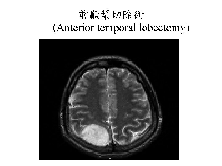 前顳葉切除術 (Anterior temporal lobectomy) 
