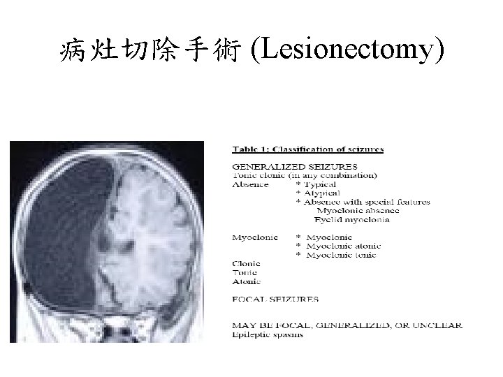 病灶切除手術 (Lesionectomy) 