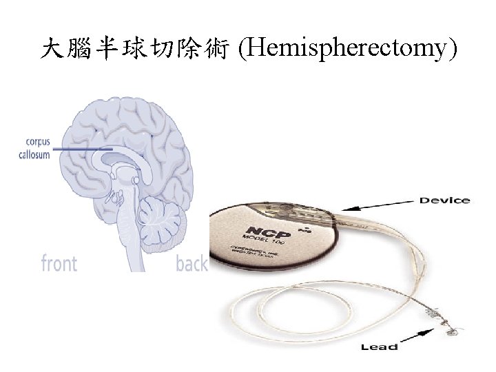 大腦半球切除術 (Hemispherectomy) 