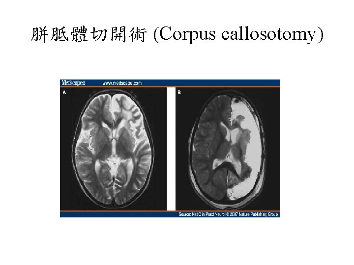 胼胝體切開術 (Corpus callosotomy) 