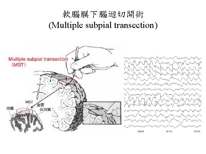 軟腦膜下腦迴切開術 (Multiple subpial transection) 