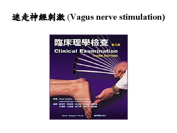 迷走神經刺激 (Vagus nerve stimulation) 