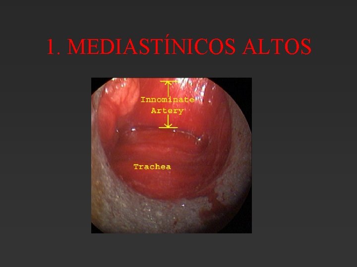 1. MEDIASTÍNICOS ALTOS 1. MEDIASTÍNICOS ALTOS