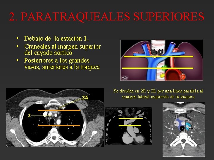 2. PARATRAQUEALES SUPERIORES • Debajo de la estación 1. • Craneales al margen superior 2. PARATRAQUEALES SUPERIORES • Debajo de la estación 1. • Craneales al margen superior