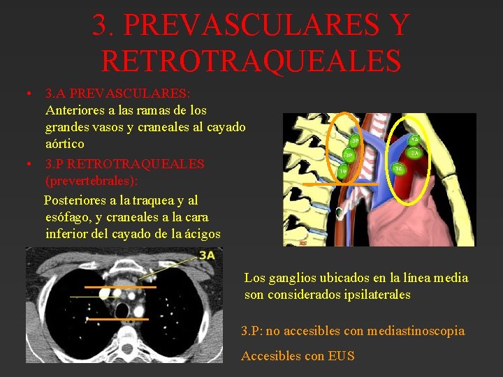 3. PREVASCULARES Y RETROTRAQUEALES • 3. A PREVASCULARES: Anteriores a las ramas de los 3. PREVASCULARES Y RETROTRAQUEALES • 3. A PREVASCULARES: Anteriores a las ramas de los