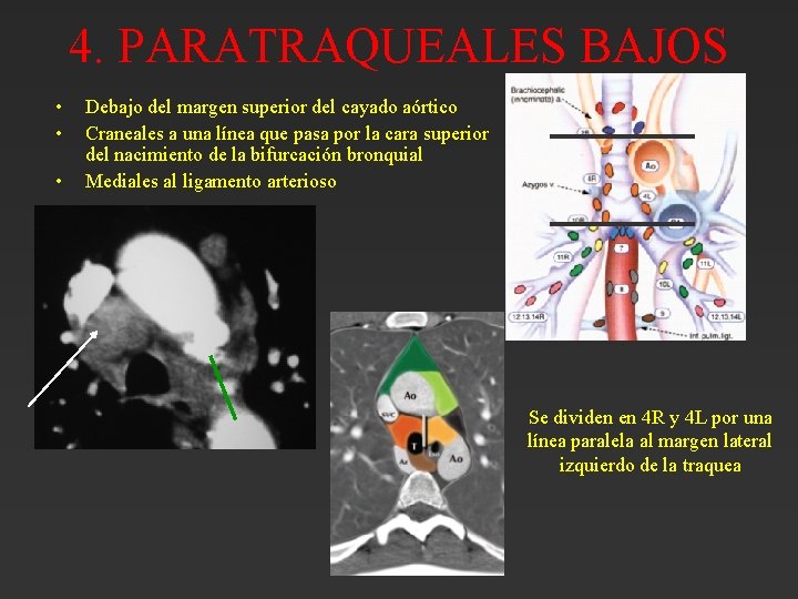 4. PARATRAQUEALES BAJOS • • • Debajo del margen superior del cayado aórtico Craneales 4. PARATRAQUEALES BAJOS • • • Debajo del margen superior del cayado aórtico Craneales