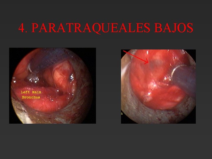 4. PARATRAQUEALES BAJOS 4. PARATRAQUEALES BAJOS