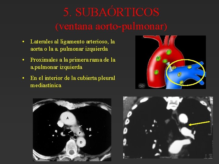 5. SUBAÓRTICOS (ventana aorto-pulmonar) • Laterales al ligamento arterioso, la aorta o la a. 5. SUBAÓRTICOS (ventana aorto-pulmonar) • Laterales al ligamento arterioso, la aorta o la a.