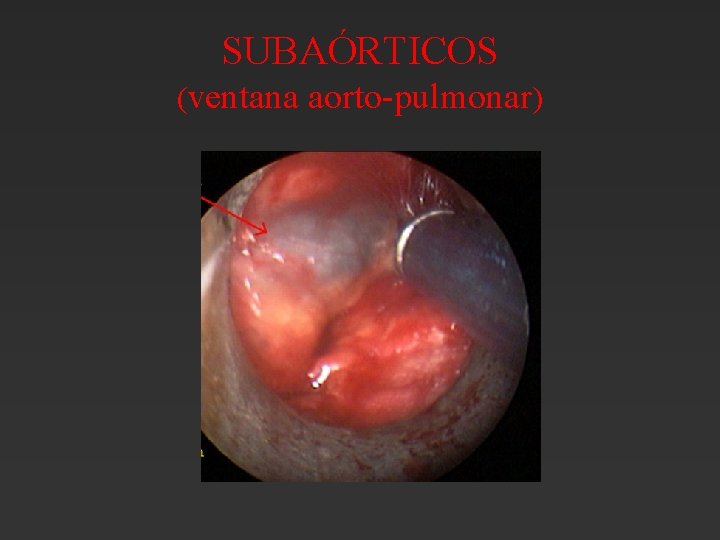 SUBAÓRTICOS (ventana aorto-pulmonar) SUBAÓRTICOS (ventana aorto-pulmonar)