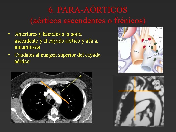 6. PARA-AÓRTICOS (aórticos ascendentes o frénicos) • Anteriores y laterales a la aorta ascendente 6. PARA-AÓRTICOS (aórticos ascendentes o frénicos) • Anteriores y laterales a la aorta ascendente