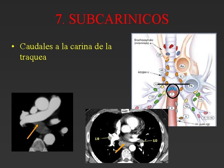 7. SUBCARINICOS • Caudales a la carina de la traquea 7. SUBCARINICOS • Caudales a la carina de la traquea