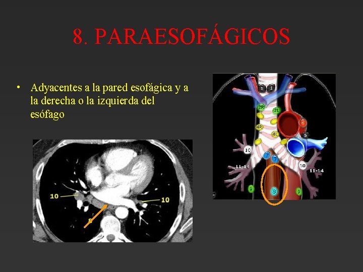 8. PARAESOFÁGICOS • Adyacentes a la pared esofágica y a la derecha o la 8. PARAESOFÁGICOS • Adyacentes a la pared esofágica y a la derecha o la