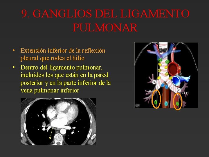 9. GANGLIOS DEL LIGAMENTO PULMONAR • Extensión inferior de la reflexión pleural que rodea 9. GANGLIOS DEL LIGAMENTO PULMONAR • Extensión inferior de la reflexión pleural que rodea