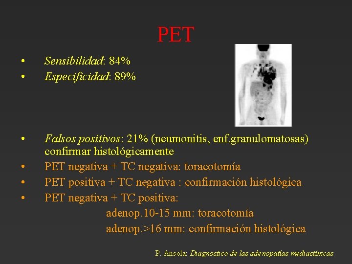 PET • • Sensibilidad: 84% Especificidad: 89% • Falsos positivos: 21% (neumonitis, enf. granulomatosas) PET • • Sensibilidad: 84% Especificidad: 89% • Falsos positivos: 21% (neumonitis, enf. granulomatosas)