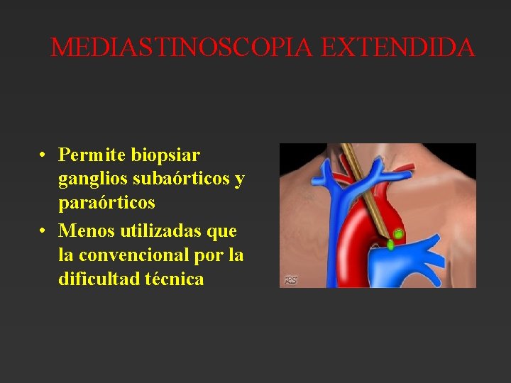 MEDIASTINOSCOPIA EXTENDIDA • Permite biopsiar ganglios subaórticos y paraórticos • Menos utilizadas que la MEDIASTINOSCOPIA EXTENDIDA • Permite biopsiar ganglios subaórticos y paraórticos • Menos utilizadas que la