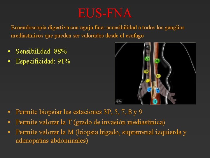 EUS-FNA Ecoendoscopia digestiva con aguja fina: accesibilidad a todos los ganglios mediastinicos que pueden EUS-FNA Ecoendoscopia digestiva con aguja fina: accesibilidad a todos los ganglios mediastinicos que pueden