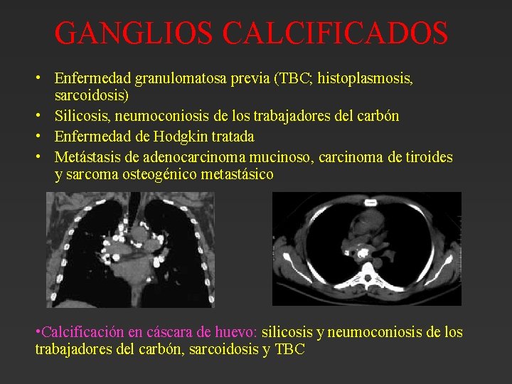 GANGLIOS CALCIFICADOS • Enfermedad granulomatosa previa (TBC; histoplasmosis, sarcoidosis) • Silicosis, neumoconiosis de los GANGLIOS CALCIFICADOS • Enfermedad granulomatosa previa (TBC; histoplasmosis, sarcoidosis) • Silicosis, neumoconiosis de los