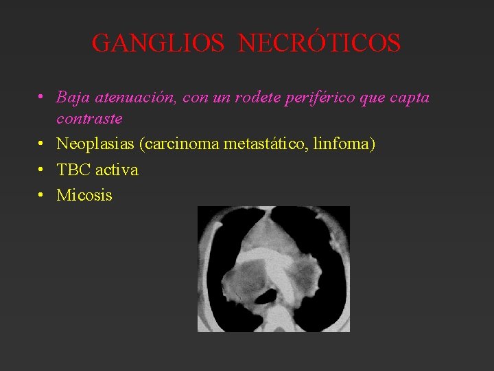 GANGLIOS NECRÓTICOS • Baja atenuación, con un rodete periférico que capta contraste • Neoplasias GANGLIOS NECRÓTICOS • Baja atenuación, con un rodete periférico que capta contraste • Neoplasias