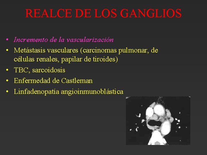 REALCE DE LOS GANGLIOS • Incremento de la vascularización • Metástasis vasculares (carcinomas pulmonar, REALCE DE LOS GANGLIOS • Incremento de la vascularización • Metástasis vasculares (carcinomas pulmonar,