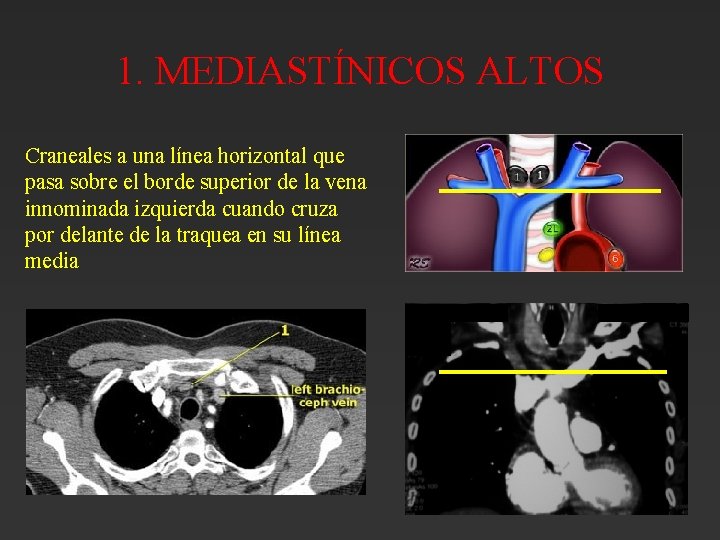 1. MEDIASTÍNICOS ALTOS Craneales a una línea horizontal que pasa sobre el borde superior 1. MEDIASTÍNICOS ALTOS Craneales a una línea horizontal que pasa sobre el borde superior