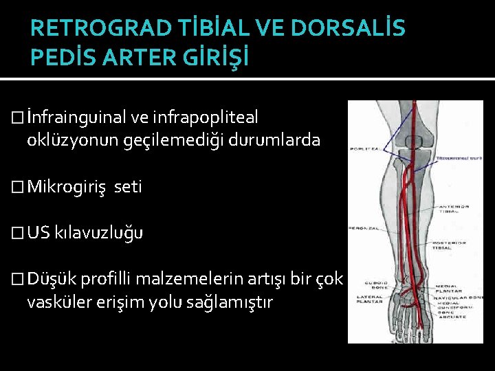 RETROGRAD TİBİAL VE DORSALİS PEDİS ARTER GİRİŞİ � İnfrainguinal ve infrapopliteal oklüzyonun geçilemediği durumlarda