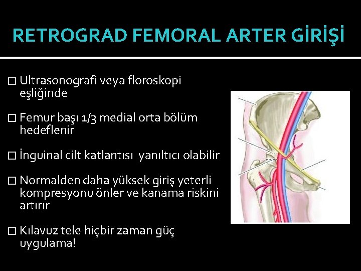 RETROGRAD FEMORAL ARTER GİRİŞİ � Ultrasonografi veya floroskopi eşliğinde � Femur başı 1/3 medial