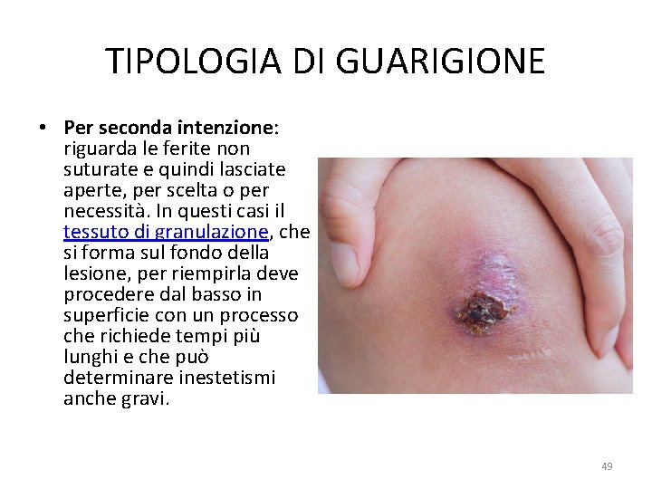 TIPOLOGIA DI GUARIGIONE • Per seconda intenzione: riguarda le ferite non suturate e quindi