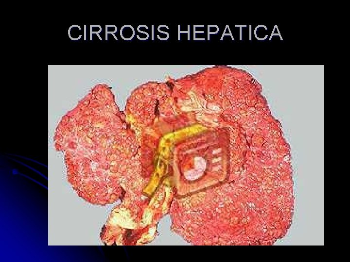 CIRROSIS HEPATICA 