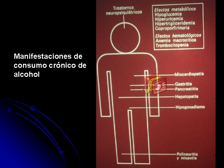 Manifestaciones de consumo crónico de alcohol 