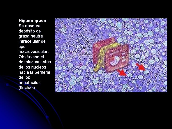 Hígado graso Se observa depósito de grasa neutra intracelular de tipo macrovesicular. Obsérvese el