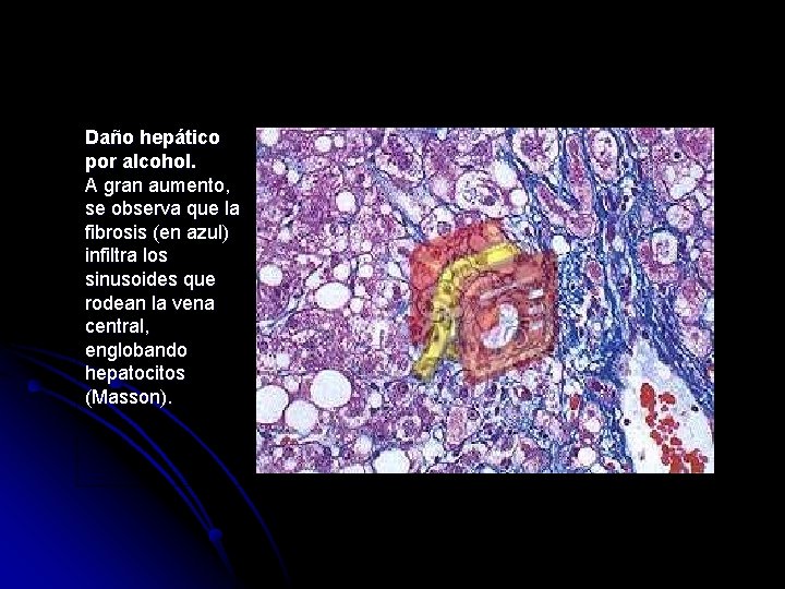 Daño hepático por alcohol. A gran aumento, se observa que la fibrosis (en azul)