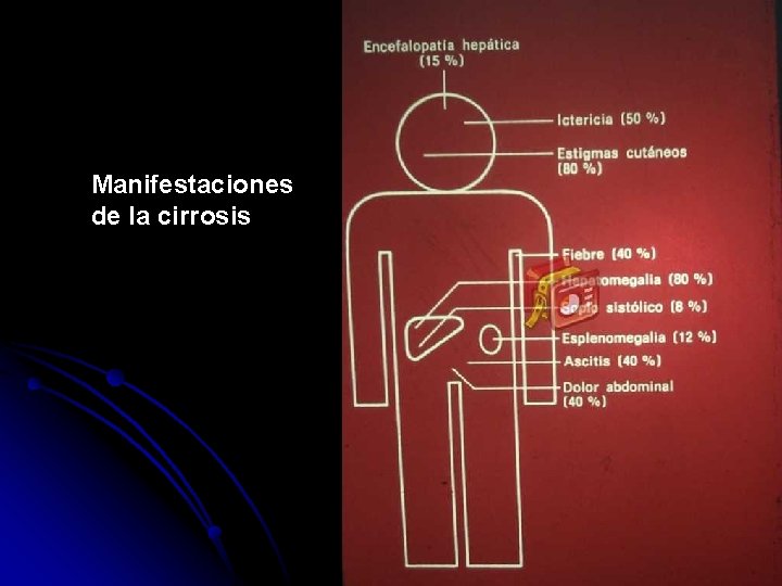 Manifestaciones de la cirrosis 