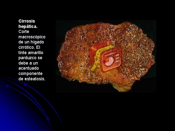 Cirrosis hepática. Corte macroscópico de un hígado cirrótico. El tinte amarillo parduzco se debe