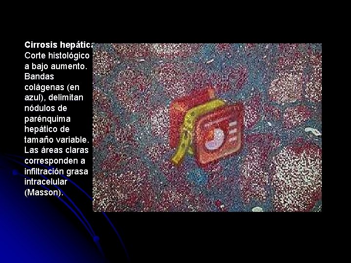 Cirrosis hepática. Corte histológico a bajo aumento. Bandas colágenas (en azul), delimitan nódulos de