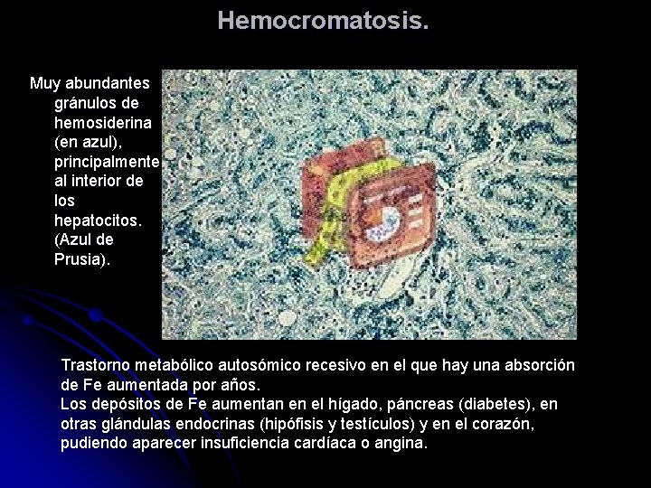 Hemocromatosis. Muy abundantes gránulos de hemosiderina (en azul), principalmente al interior de los hepatocitos.