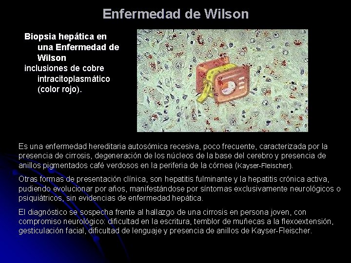 Enfermedad de Wilson Biopsia hepática en una Enfermedad de Wilson inclusiones de cobre intracitoplasmático