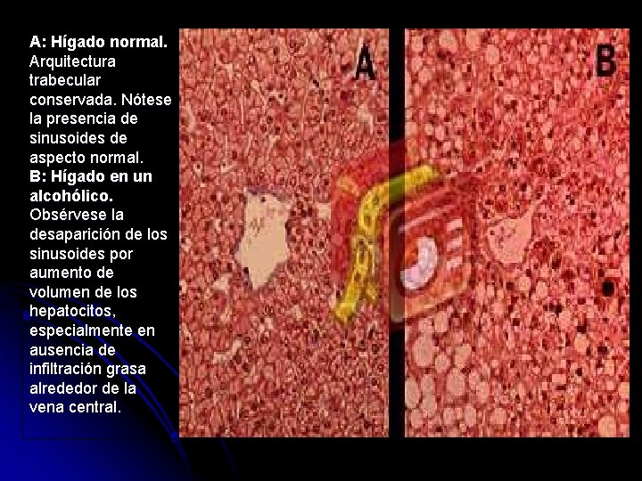 A: Hígado normal. Arquitectura trabecular conservada. Nótese la presencia de sinusoides de aspecto normal.