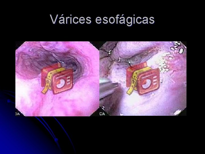 Várices esofágicas 
