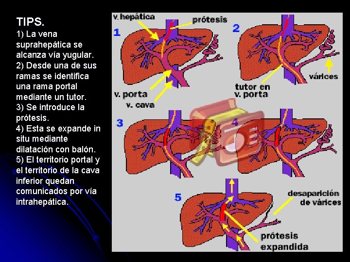 TIPS. 1) La vena suprahepática se alcanza vía yugular. 2) Desde una de sus