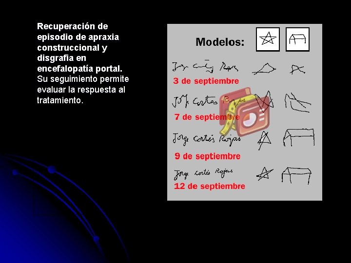 Recuperación de episodio de apraxia construccional y disgrafia en encefalopatía portal. Su seguimiento permite