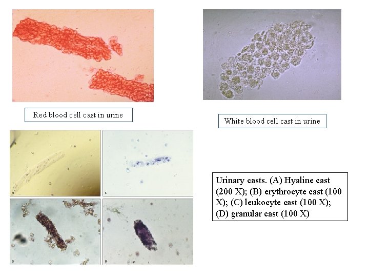 Red blood cell cast in urine White blood cell cast in urine Urinary casts.