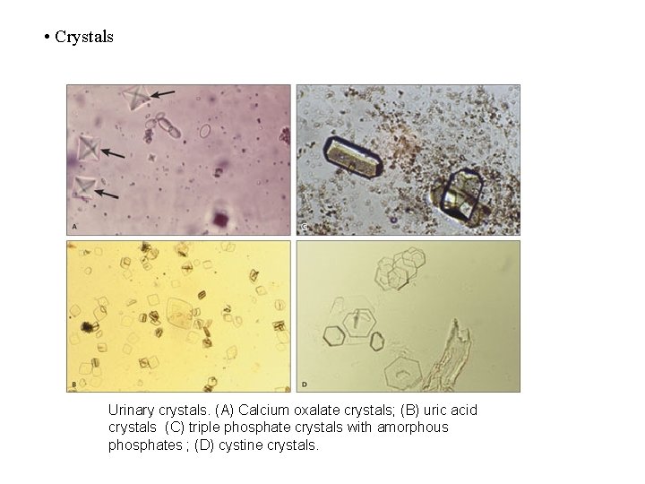  • Crystals Urinary crystals. (A) Calcium oxalate crystals; (B) uric acid crystals (C)