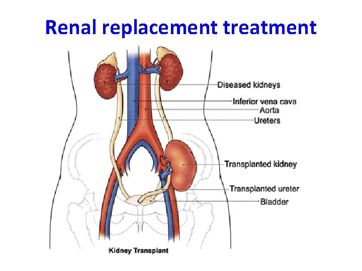 Renal replacement treatment 