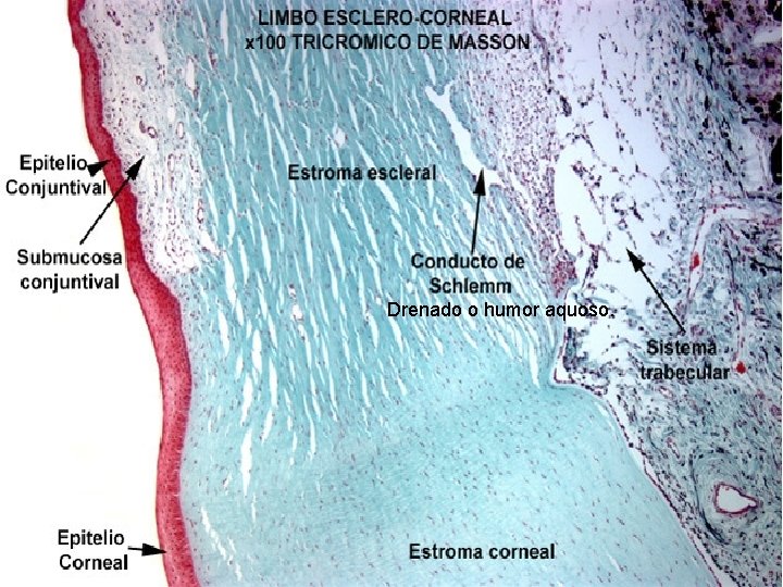Drenado o humor aquoso. 