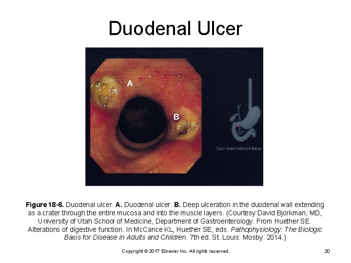 Duodenal Ulcer Figure 18 -6. Duodenal ulcer. A. Duodenal ulcer. B. Deep ulceration in