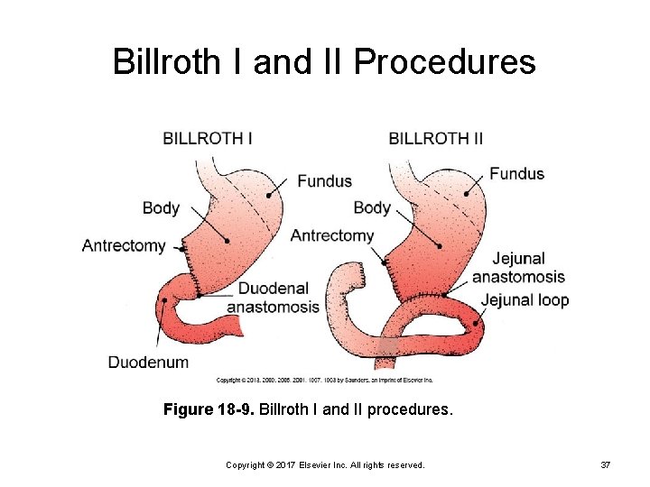 Billroth I and II Procedures Figure 18 -9. Billroth I and II procedures. Copyright