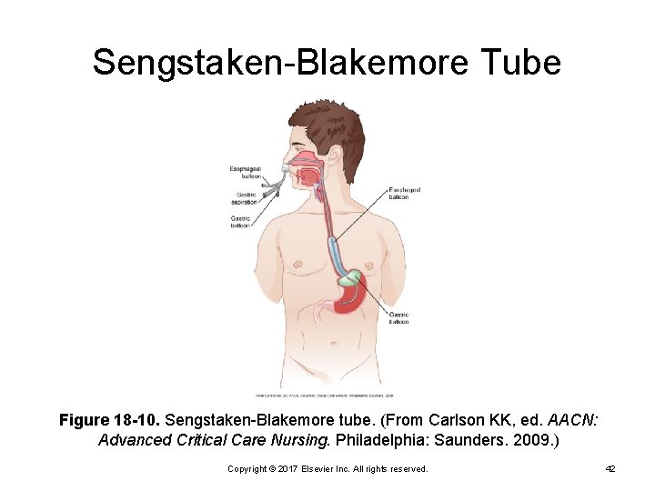 Sengstaken-Blakemore Tube Figure 18 -10. Sengstaken-Blakemore tube. (From Carlson KK, ed. AACN: Advanced Critical