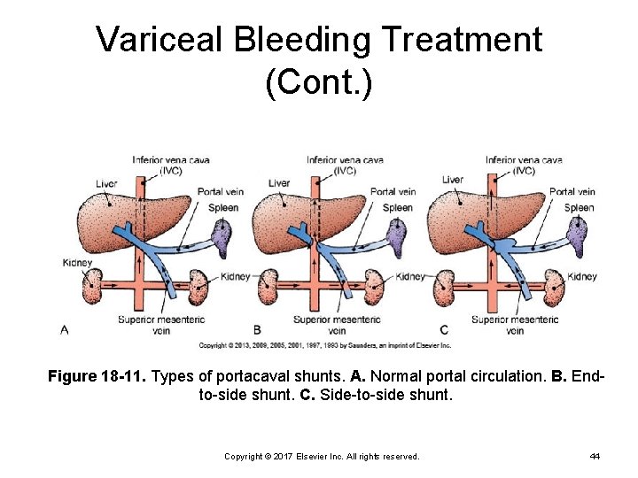 Variceal Bleeding Treatment (Cont. ) Figure 18 -11. Types of portacaval shunts. A. Normal