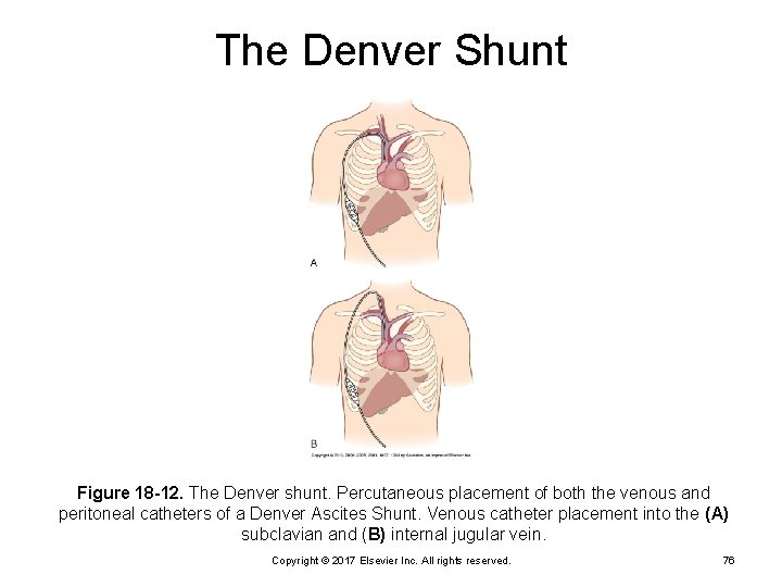 The Denver Shunt Figure 18 -12. The Denver shunt. Percutaneous placement of both the