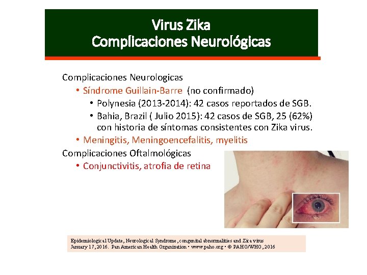 Virus Zika Complicaciones Neurológicas Complicaciones Neurologicas • Síndrome Guillain-Barre (no confirmado) • Polynesia (2013